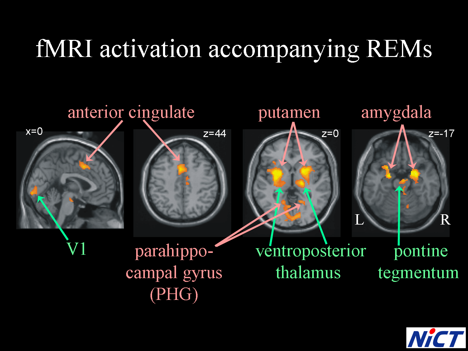 Brain Activation Accompanying Rems During Rem Sleep